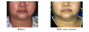 Scar revision before and after - UNC Center for Facial Aesthetics 