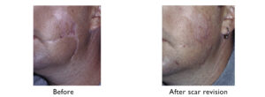 Before and after images for scar revision