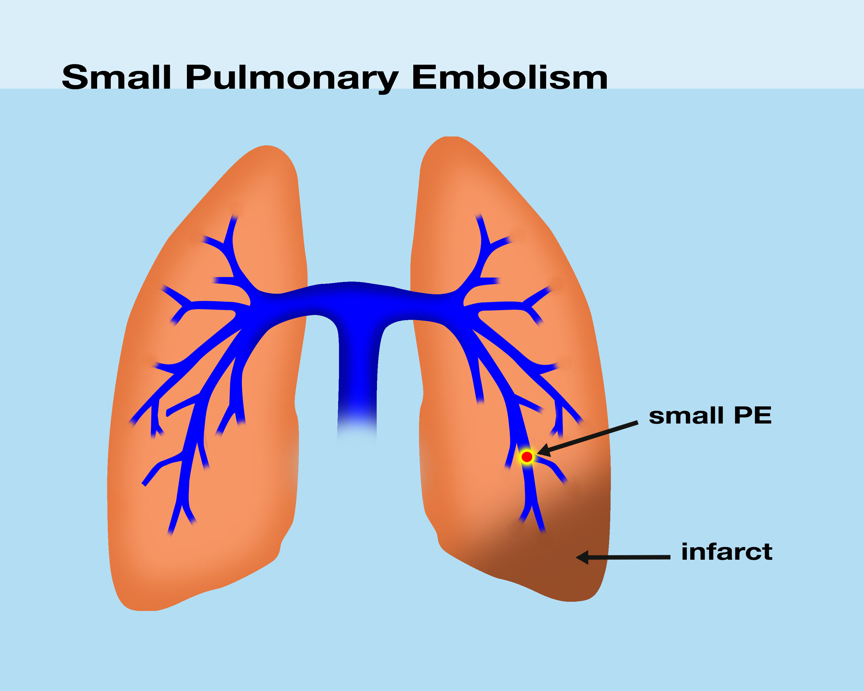 Pulmonary Embolism Small