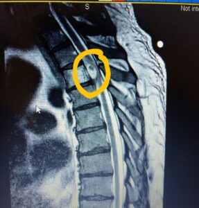 MRI image of Butch's spine tumor