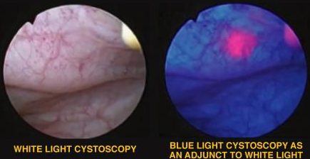 procedures cystoscopy urology light blue
