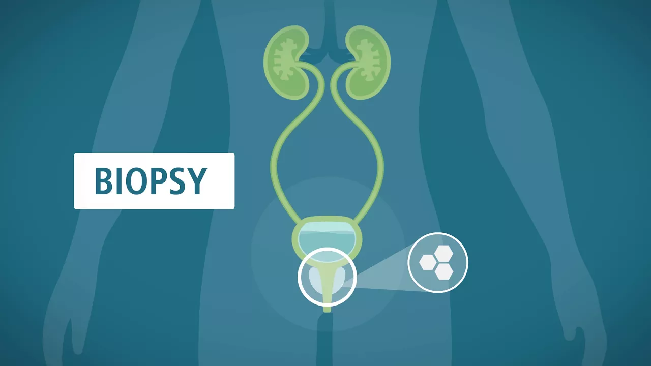 Prostate Biopsy What You Should Know Department Of Urology 2286